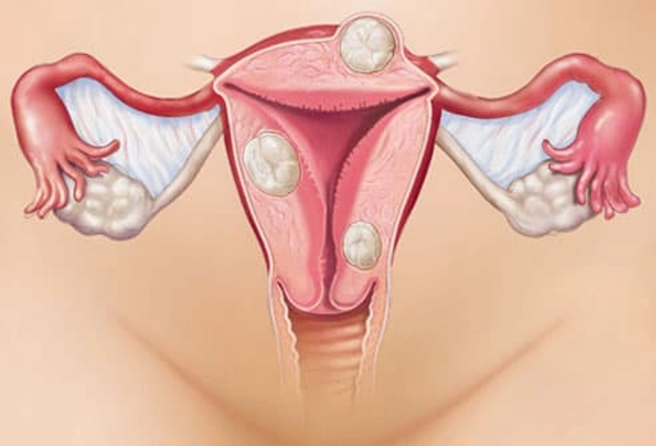 can endometriosis be cured?